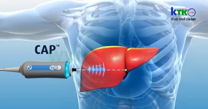 FibroScan – Kỹ thuật siêu âm đo độ đàn hồi gan.